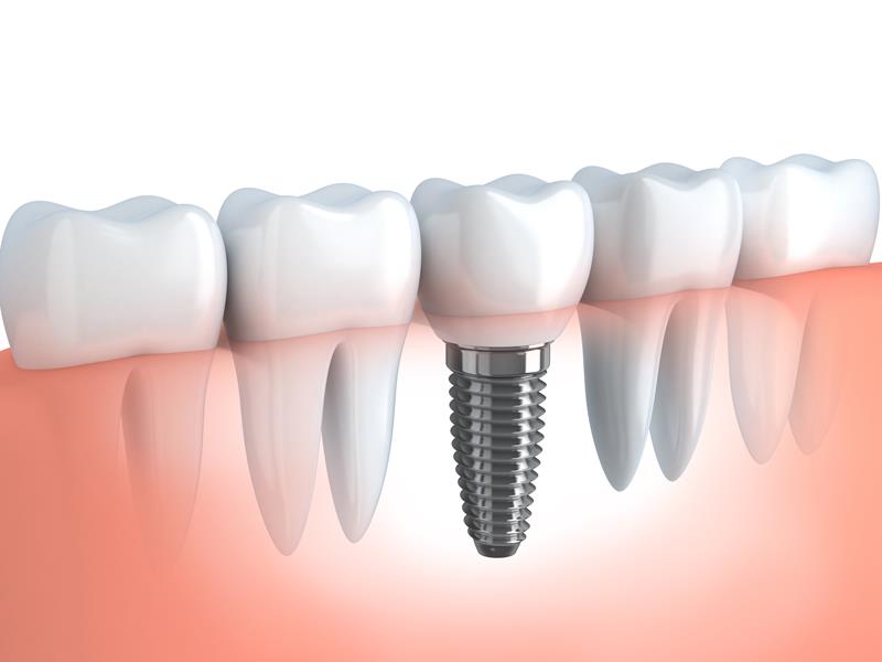 Dental Implants used at Sheets Dental, Federal Way, WA 